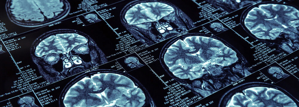 brain scan image in westchester, new york. patient needs a brain injury attorney